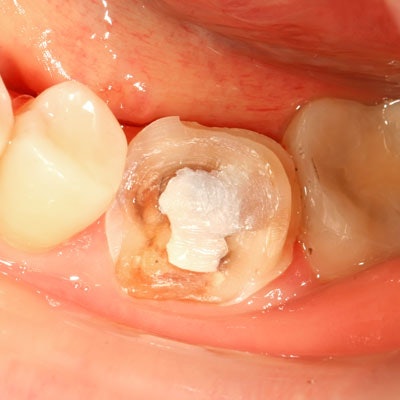 OrVance launches temporary tooth repair product